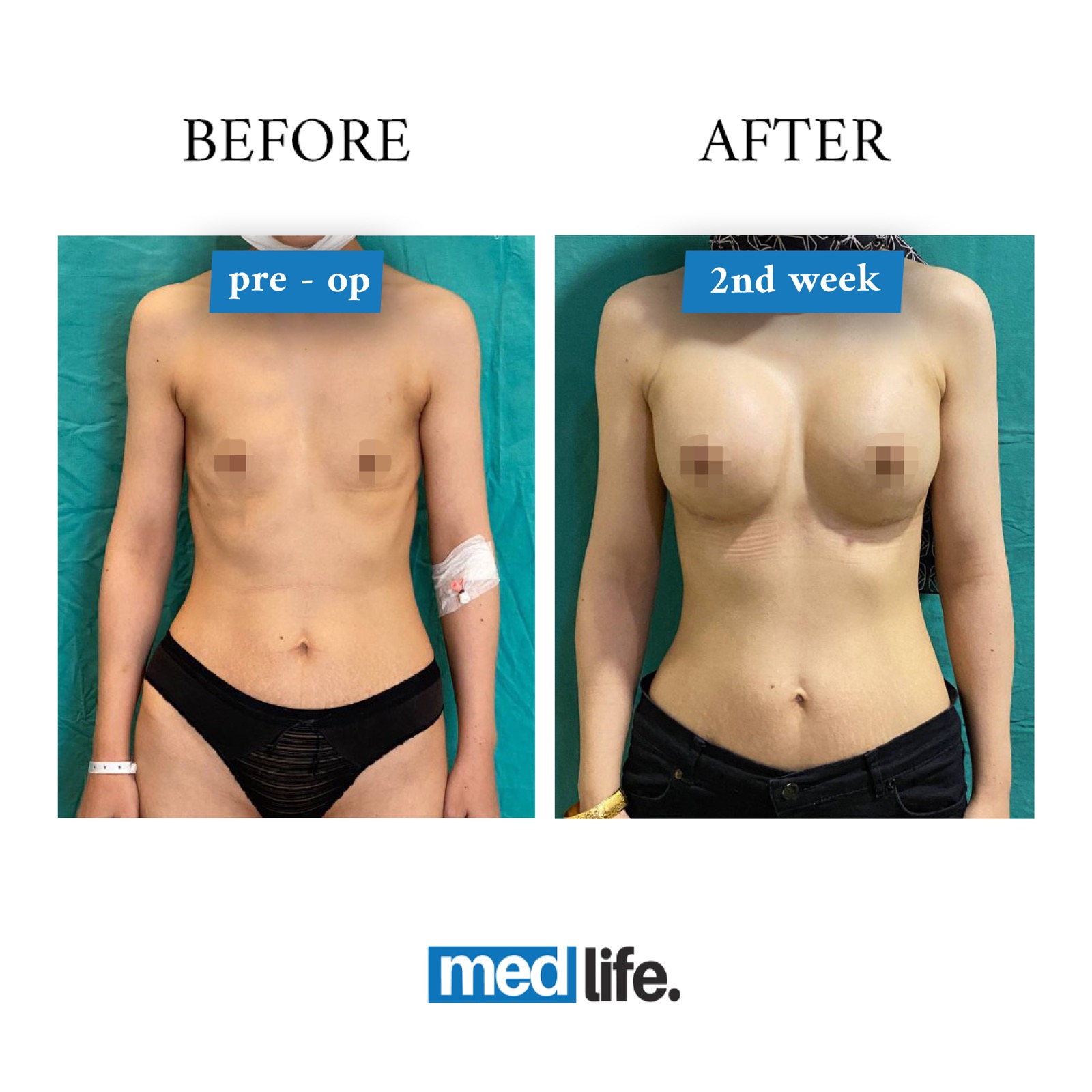 Medlife Group on X: Roxanne, from UK 🇬🇧 chose Medlife Group for her  Breast Implant! We love how balanced her body is looking!⁣ Breast Lift with  Implants!⁣ 2 Weeks Post-Op! 💫 #breastreduction #