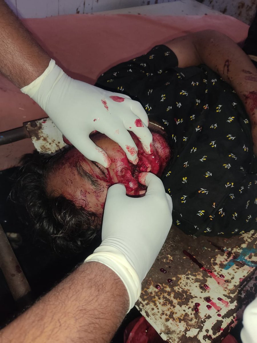 JunaidADB's tweet photo. @KTRTRS @SonuSood @SmitaSabharwal Sir/mam,a boy from adilabad met with Accident yesterday night. Admitted in wellness hospital ameerpet
He had head injury, in critical condition.Need urgent surgery 
Kindly help🙏
Contact:+91 80744 26108
@KTRoffice
@Nikhini_Varma @karingulapranay https://t.co/zuF35qQlPS