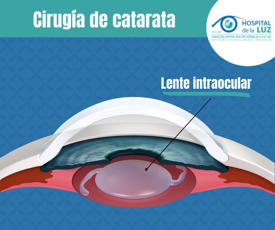 HospitaldelaLuz's tweet photo. En el proceso de cirugía de catarata, el oftalmólogo reemplazará la lente natural opacificada por una nueva lente artificial. https://t.co/6DppxZHWnn