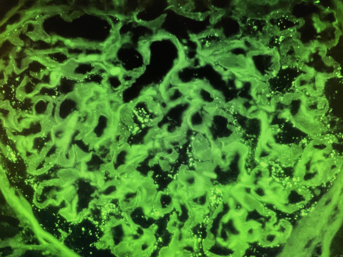 AstridWeins's tweet image. #antinephrin strikes again: MCD from live on service with not so subtle podocyte IgG in the biopsy. Patient has 7g of proteinuria and is nephrotic.
