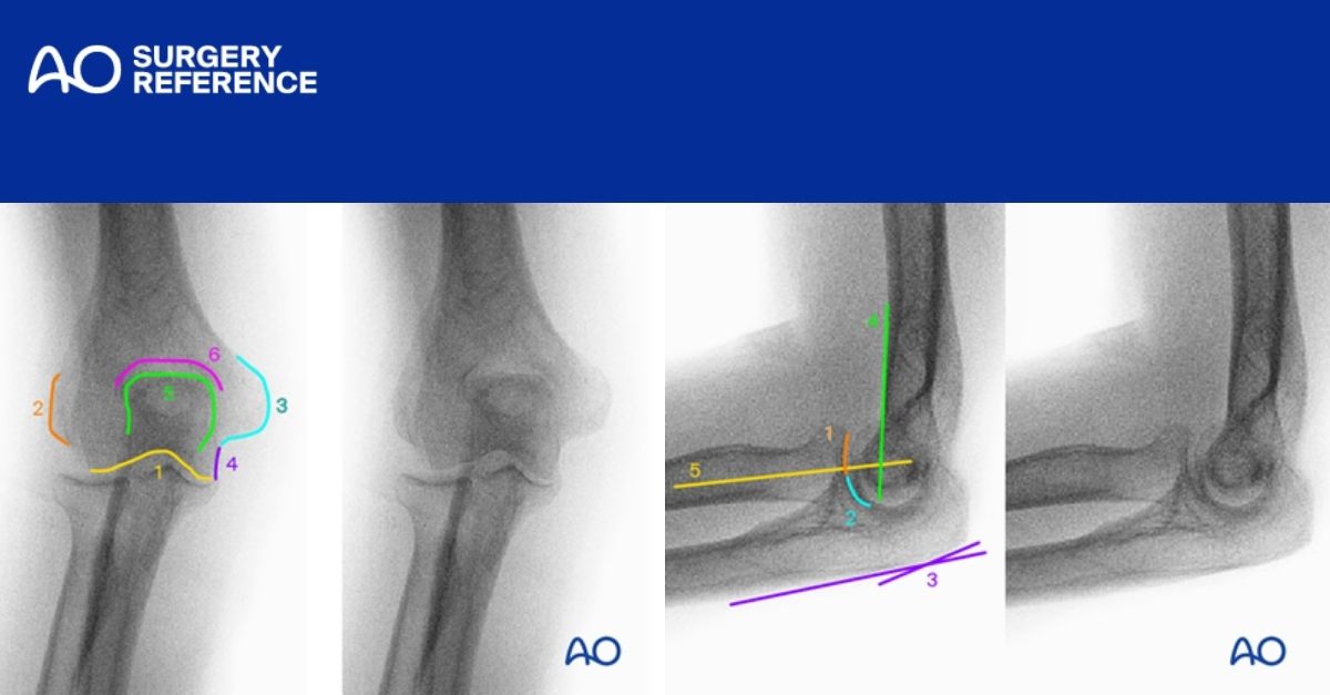AOFoundation's tweet photo. NEW #AOsurgeryreference modules of the distal humerus and proximal forearm have been supplemented with an intraoperative imaging page.
Distal humerus β‘οΈ https://t.co/84qyWDXlz8
Proximal forearm β‘οΈ https://t.co/a62gbhiA8O
#intraoperative #orthopedic #AOtrauma https://t.co/Jk2uPVD13r
