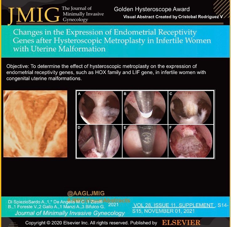 AAGLJMIG's tweet photo. #JMIGVisualAbstract celebrating award winning research, this year the Golden Hysteroscope  award for Best paper on Hysteroscopy goes to Dr Spiezo et al for Changes in the Expression of Endometrial Receptivity Genes after Hysteroscopic Metroplasty in Infertile Women @AAGL #AAGL21 https://t.co/dUPr0f7Tha