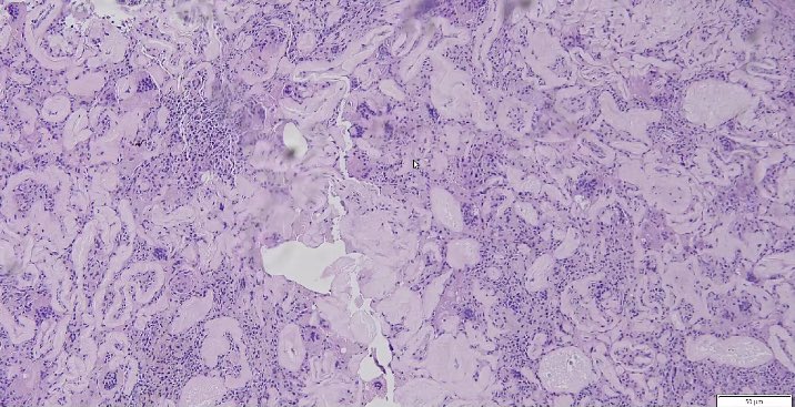 Day16- <a href="/loyolapathology/">Loyola Pathology & Laboratory Medicine</a>               Pulse granuloma!! They are hyaline rings with admixed multinucleated giant cells; the term ‘pulse’ refers to edible seeds of legume vegetables #Histopath #Pathtwitter #Twitterhomework #PathElective <a href="/KMirza/">Kamran Mirza MD PhD - کامران مرزا</a>
