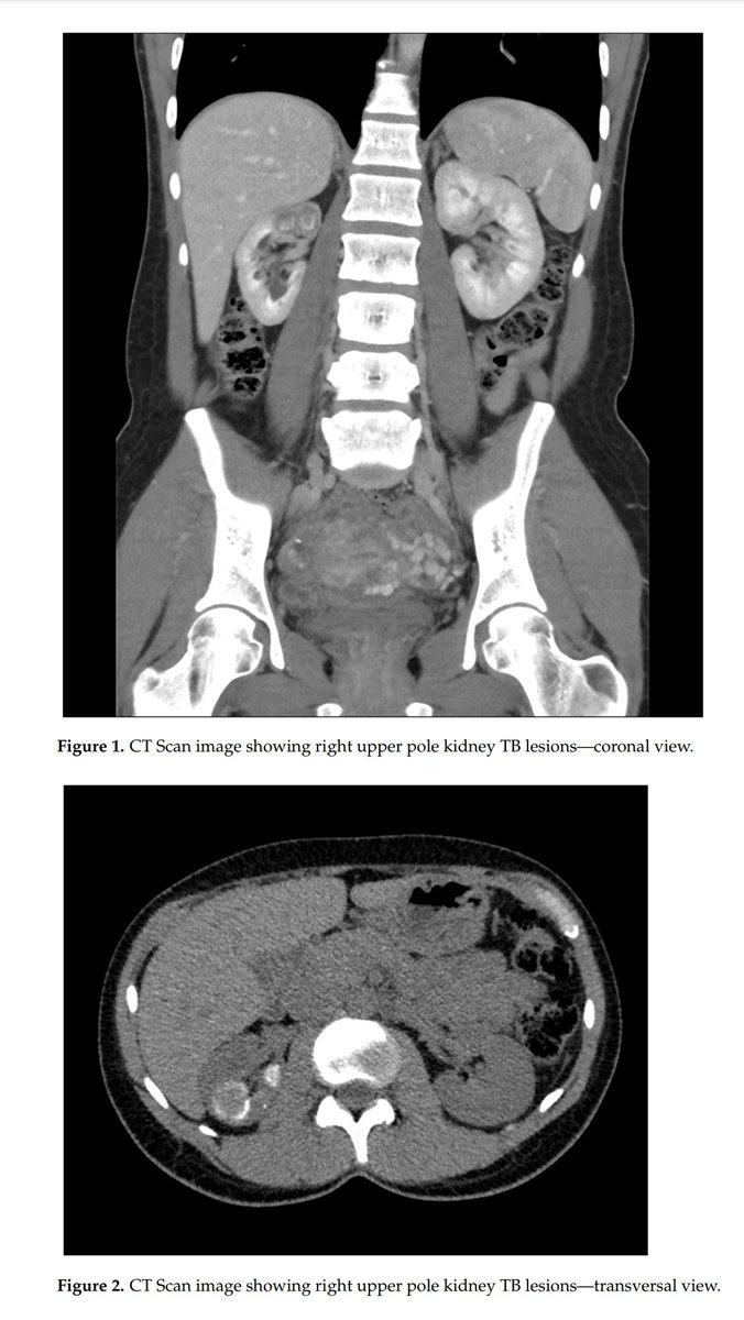 ManticaGu's tweet photo. Here our comprehensive review on etiology, pathogenesis, diagnosis, management and follow up of #GUTB. A often neglected diseases by European urologists. #urosome #urology @RiccardiNiccolo @Ambrosini_F @Chico_Vec @GBonkat @riccabar1 https://t.co/JTEOD2YMpY