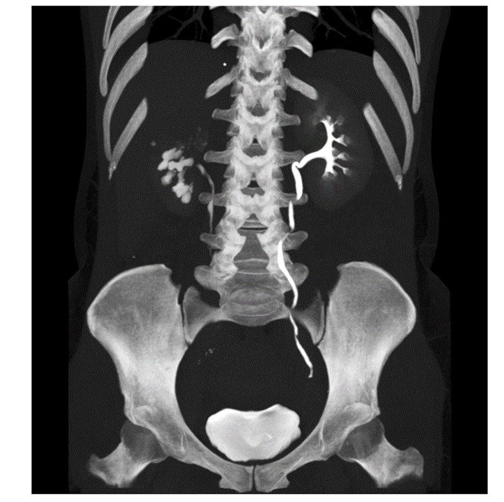 ManticaGu's tweet photo. Here our comprehensive review on etiology, pathogenesis, diagnosis, management and follow up of #GUTB. A often neglected diseases by European urologists. #urosome #urology @RiccardiNiccolo @Ambrosini_F @Chico_Vec @GBonkat @riccabar1 https://t.co/JTEOD2YMpY