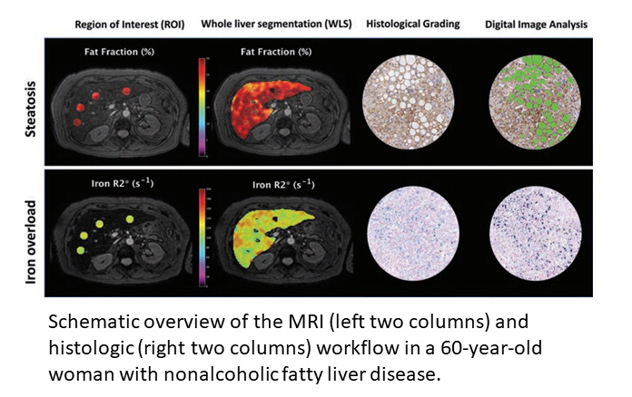 aalberich's tweet photo. Thrilled to see the validation study of @QuibimBiomarker automated #AI algorithm for #virtualbiopsy in #chronic #liver #disease published today in @radiology_rsna journal.
https://t.co/gD5EX4yTeU https://t.co/yaz6FssUdi