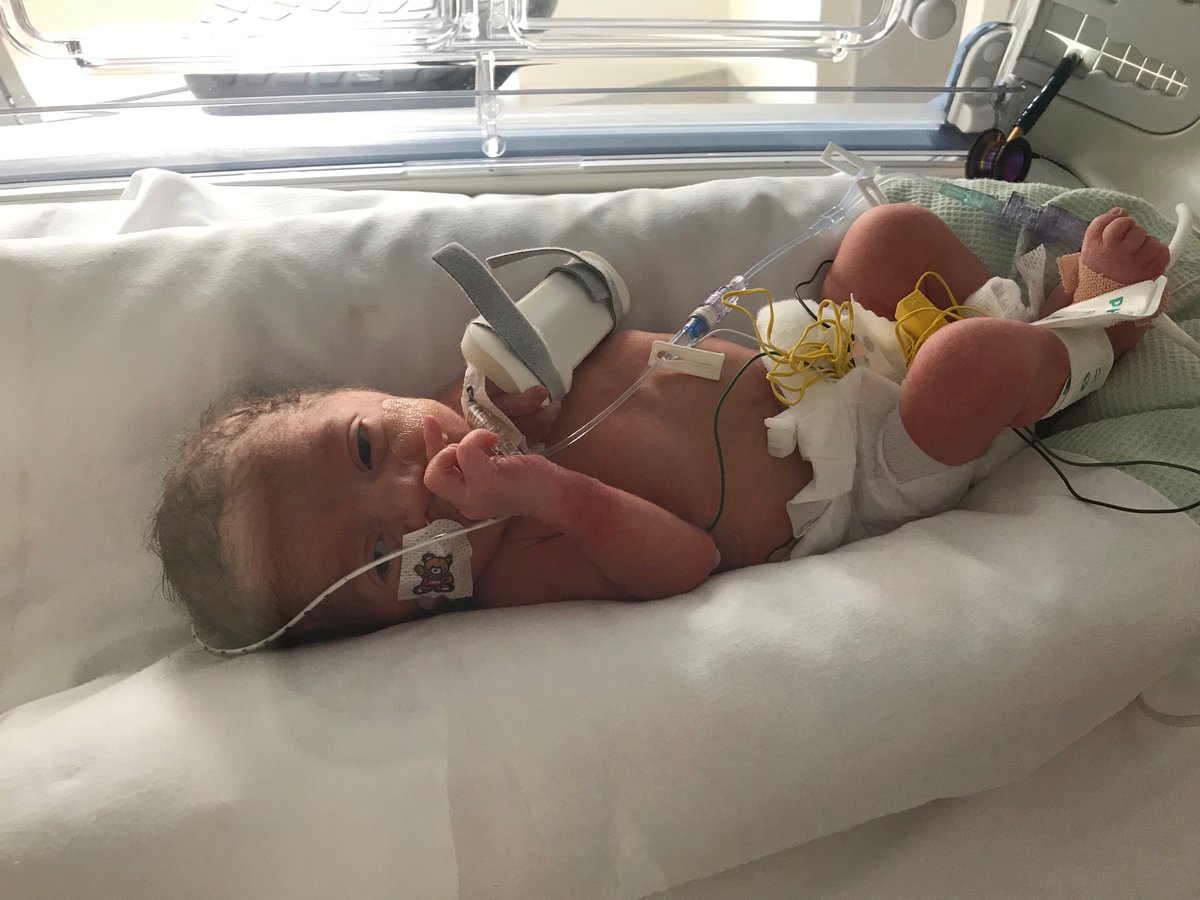 Hayley_k83's tweet photo. @MFT_SMH @EatonKath @AlisonODoherty2 @EmmaBird2021 @zoestep59638187 @ngozi_ediosagie @Holly_Kn Amari Rose born at 34 weeks weighing 4lbs #tinyandmighty now 17 months old x https://t.co/l3QD5pc5Kb