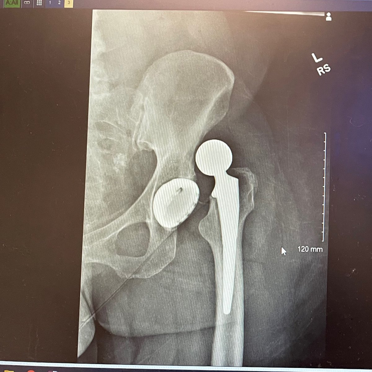 kriztinaVA's tweet photo. So this happened today.. Yup dislocated my new hip.. Very rare #dislocatedhip #owie #specialk @PeriQuizFans https://t.co/jjaFRobIVn