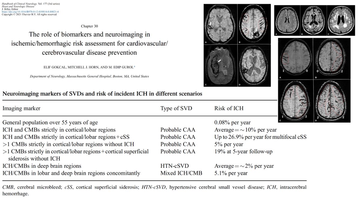 Edip Gurol (@guroledip) on Twitter photo @SchreuderFloris <a href="/CAA_Disease/">Amyloid Angiopathy</a> <a href="/CAAcure/">Cerebral Amyloid Angiopathy</a> <a href="/DutchCAAFoundat/">CAA Foundation</a> Thanks for emphasizing this very important issue that is often underestimated. The brain MRI should also include a hemosiderin sequence and the radiologist/neurologist need to review such T2*/GRE/SWI. <a href="/CAA_Disease/">Amyloid Angiopathy</a> @SchreuderFloris <a href="/CAA_Disease/">Amyloid Angiopathy</a> <a href="/CAAcure/">Cerebral Amyloid Angiopathy</a> <a href="/DutchCAAFoundat/">CAA Foundation</a> Thanks for emphasizing this very important issue that is often underestimated. The brain MRI should also include a hemosiderin sequence and the radiologist/neurologist need to review such T2*/GRE/SWI. <a href="/CAA_Disease/">Amyloid Angiopathy</a>