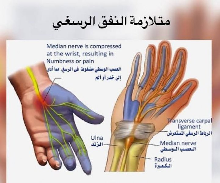 #التنميل له اسباب كثيرة، من اهمها مرض #السكر ، ولذلك يجب ان نفرق بينها وبين ضغط العصب عند اليد، وذلك بعمل تخطيط ل #الاعصاب
فاذا كان التشخيص صحيح، فهناك عدة علاجات لمتلازمة النفق الرسغي
حسب حالة المريض وشدة المرض