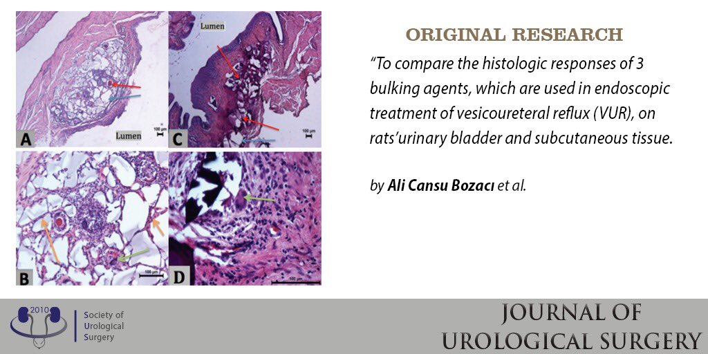 JUsurgery's tweet photo. Comparision of The Histologic Response to Different Bulking Materials Used in Endoscopic Vesicoureteral Reflux Surgery
 
Read a Original Research by Ali Cansu Bozacı and colleagues.
#Vesicoureteralreflux #endoscopictreatment #injectionmaterials
Here: https://t.co/aKO4t08eE0 https://t.co/aNMdpOJPnl