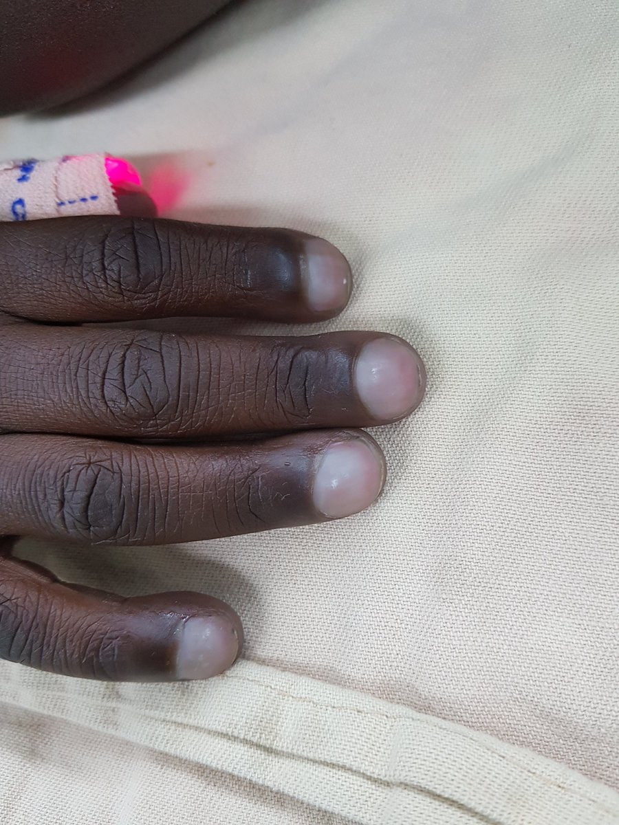 S2Surgeon's tweet photo. "2021 Ethiopia Cardiac Surgical Capacity-Building Program"
Clubbing due to Severe cyanosis with Congenial Heart Disease.
Hematocrit 63, SaO2 60%
Global Sugery Program is essential. https://t.co/JpFxqoncIy