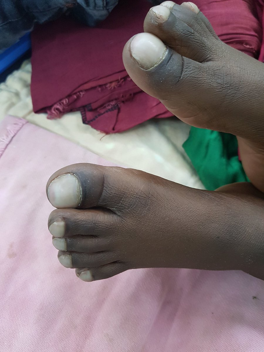 S2Surgeon's tweet photo. "2021 Ethiopia Cardiac Surgical Capacity-Building Program"
Clubbing due to Severe cyanosis with Congenial Heart Disease.
Hematocrit 63, SaO2 60%
Global Sugery Program is essential. https://t.co/JpFxqoncIy
