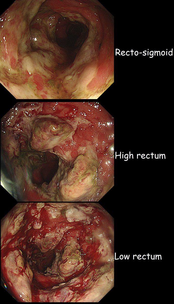 Elderly lady admitted following a stroke.  Complains of abdominal pain and some PR bleeding and these are the endoscopic findings. 
WHAT IS THE MOST LIKELY DIAGNOSIS?
a) Ulcerative colitis
b) Stercoral colitis
c) Crohn's colitis
d) Ischaemic colitis
