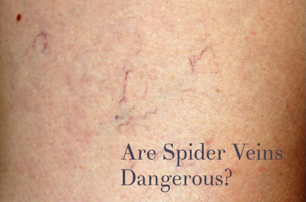 NaturalHealng's tweet photo. Spider veins are painless and tend to show up on the face or legs.
Spider veins aren't physically harmful. 
#spiderveins #varicoseveins #health #healthyskin https://t.co/8s65raRTbh