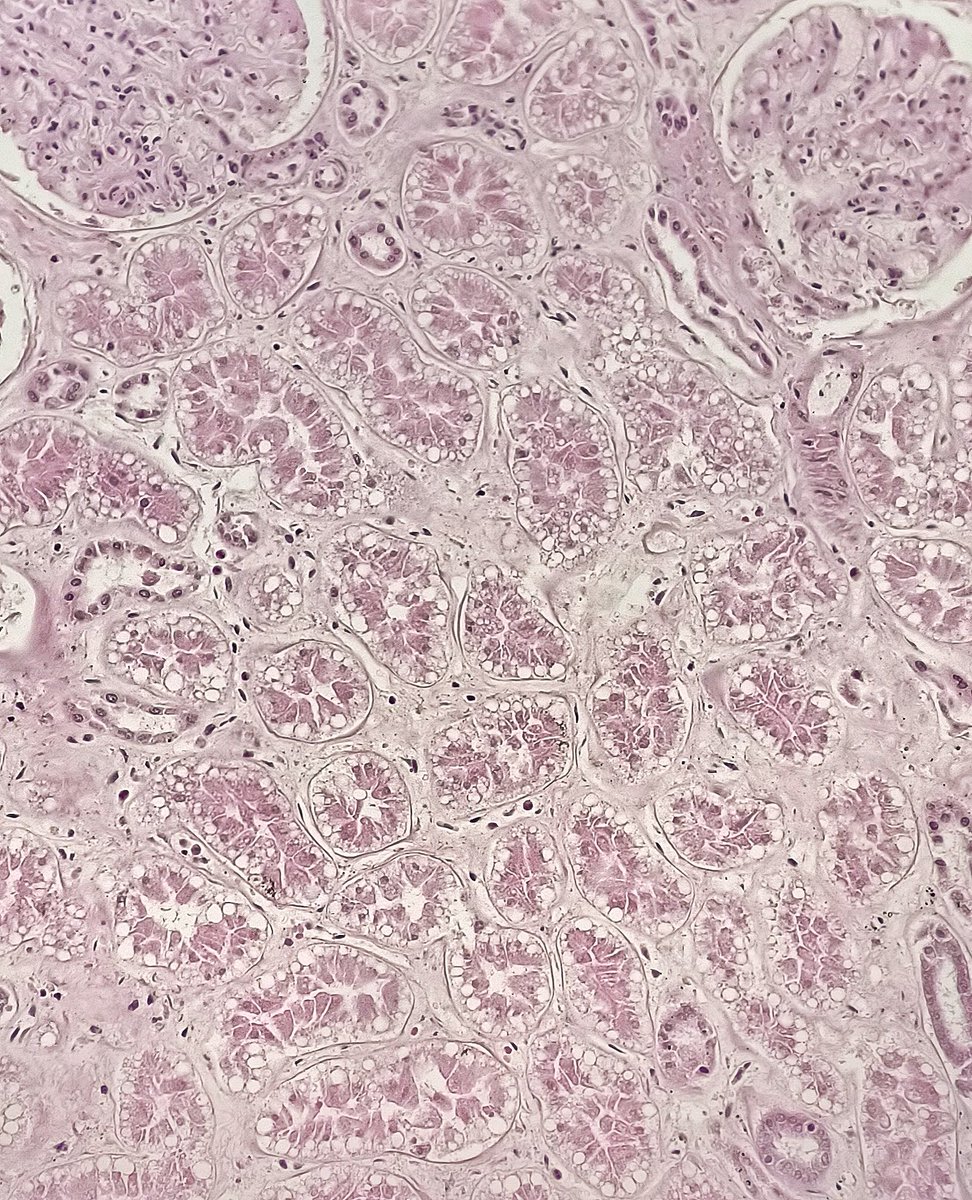 JonLaiMD's tweet photo. Subnuclear vacuolations of the renal tubular cells, seen in autopsies with ketoacidosis (diabetic or alcoholic). What are these lesions called? Hint: Sounds like a fancy suit 😉 #collections #autopsypathology https://t.co/UPOBPhN0Y5