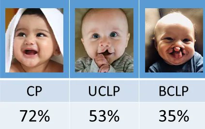 CRANE_News's tweet photo. Can the type of cleft a child is born with influence speech❓ 
7 out of 10 children with a #CP achieved normal speech compared with 5 out of 10 children with a #UCLP and 3 out of 10 children with a #BCLP.

👉 View https://t.co/ckRXULLGX5

A @CFSGBI  @CLAPACOMMUNITY collaboration https://t.co/QqSn3cf2cS
