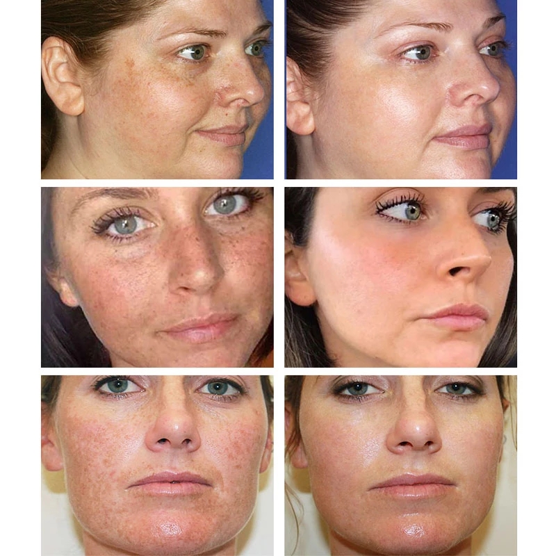 Glow_Up_Mindset's tweet photo. @HRMIrene Whitening Freckle Cream Remove Melasma Cream Remove Dark Spots Melanin Melasma Remover Brighten Skin Anti-Aging Skin Lightening
#WhiteningFreckleCream #FreckleCream #RemoveDarkSpots
https://t.co/6W6K5A5vvu https://t.co/VKfC7xLAM8