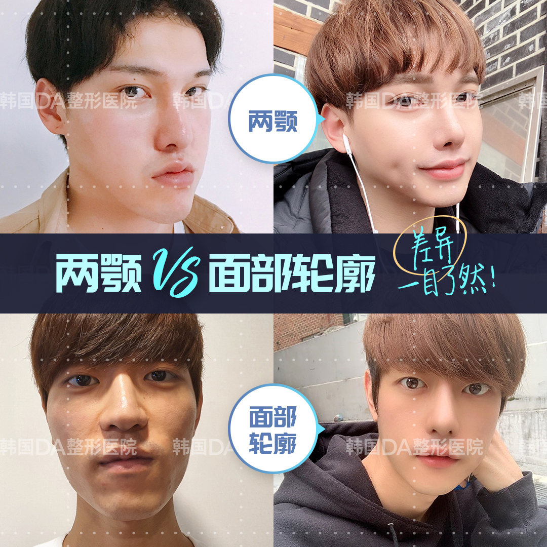 韓國da整形外科on Twitter 面部不对称 对脸型不满意 线条不流畅 没关系 Da轮廓手术可以帮你轻松塑造精致上镜脸 咨詢微信 Daprscn 5 Line Daprscn 5 韩国整形 韩国轮廓 脸型 线条 面部不对称 韩国da整形医院 T Co Ed8hkedoom Twitter