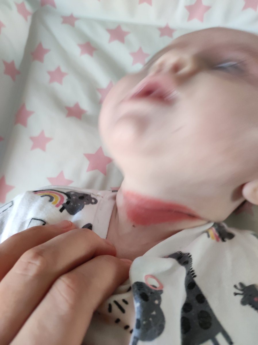 chelsc182's tweet photo. Bought this sleeping bag from @Primark this is what it's done to my baby overnight.  I'm actually disgusted, please do not buy these bags! I don't want it happening to anyone else. https://t.co/KgVTIpZyx0