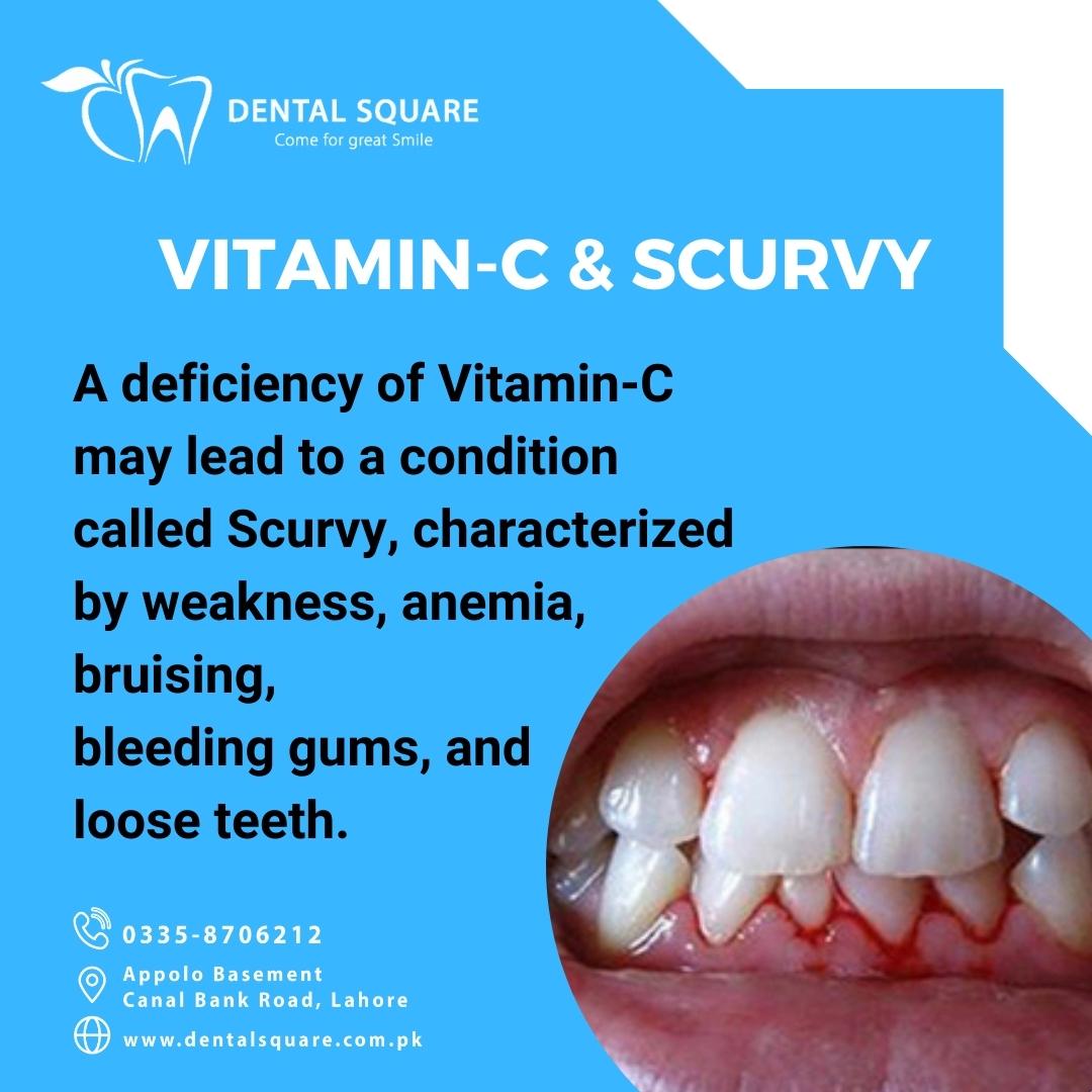 Scurvy Teeth scurvy-teeth
