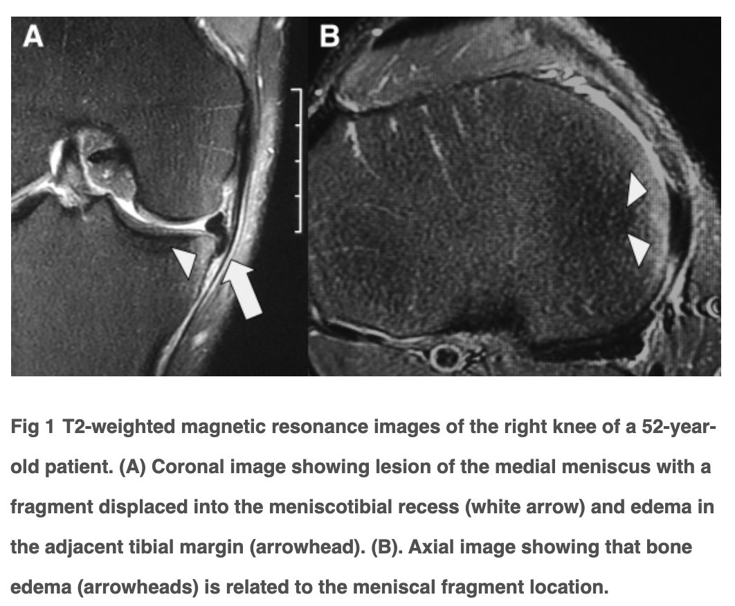 Arthroscopy Journal (@arthroscopyj) on Twitter photo A new study finds good results for arthroscopic surgical treatment of medial meniscus tears with flap displaced into meniscotibial recess and peripheral tibial bony edema: ow.ly/toKK50GHOQv #meniscus #knee #arthroscopy #surgery #ortho #orthopedic <a href="/camilo_helito/">Camilo P. Helito MD, PhD</a> A new study finds good results for arthroscopic surgical treatment of medial meniscus tears with flap displaced into meniscotibial recess and peripheral tibial bony edema: ow.ly/toKK50GHOQv #meniscus #knee #arthroscopy #surgery #ortho #orthopedic <a href="/camilo_helito/">Camilo P. Helito MD, PhD</a>