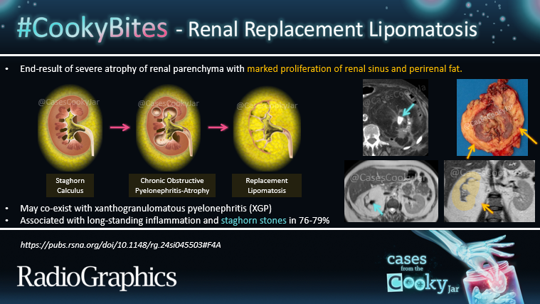 Cases From the Cooky Jar (@casescookyjar) on Twitter photo Answer: Renal Replacement Lipomatosis
Learn more:🔗 pubs.rsna.org/doi/10.1148/rg…
#CookyBites #RGphx <a href="/cookyscan1/">Cooky Menias</a> <a href="/RadioGraphics/">RadioGraphics</a> Answer: Renal Replacement Lipomatosis
Learn more:🔗 pubs.rsna.org/doi/10.1148/rg…
#CookyBites #RGphx <a href="/cookyscan1/">Cooky Menias</a> <a href="/RadioGraphics/">RadioGraphics</a>