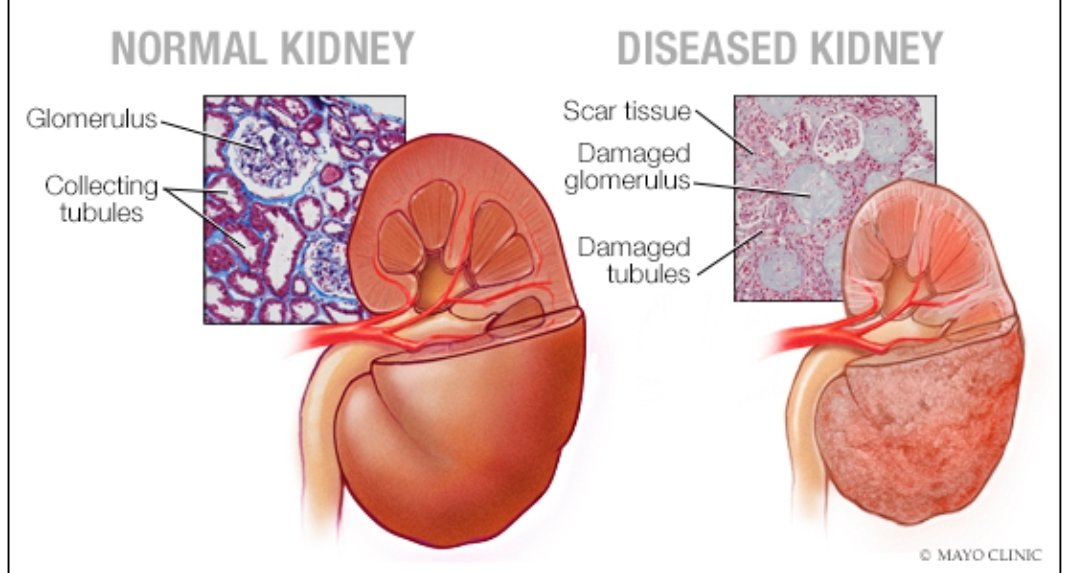 نتحدث بإذن الله عن #الفشل_الكلوي الحاد و قبل البدء بالحديث أشارك معكم اهم وظائف الكليتين : تخليص الج...