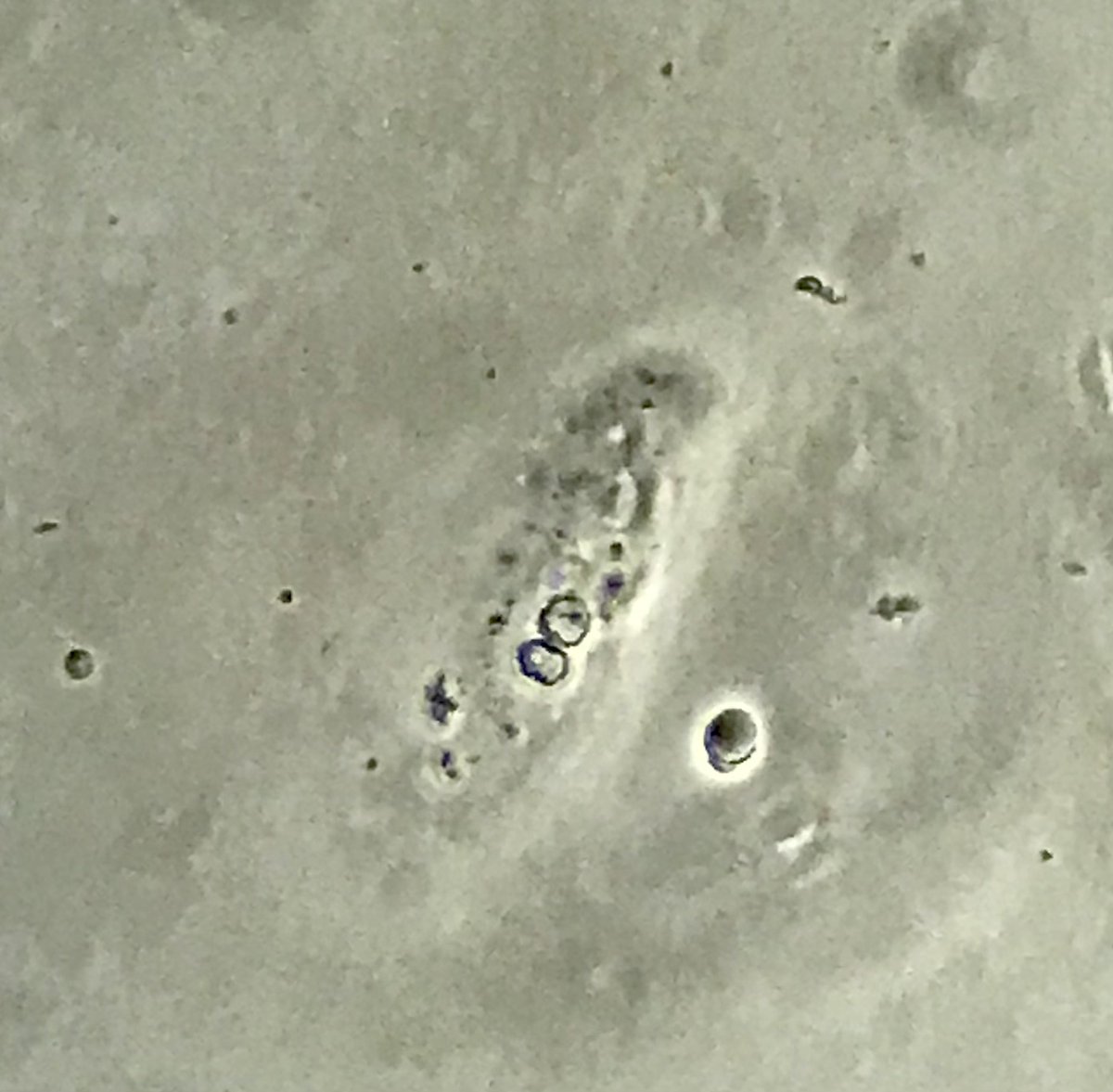 SarahRosenbloo3's tweet photo. Pt reports to clinic for evaluation of CKD of unclear etiology. 2-3+ protein on dipstick since 2019. On ARB. A few RBCs on dipstick. Non-diabetic. Well-controlled BP. Possible biopsy pending US results. #acanthocytes #RBCcast #renaltubularcellcast #spinurine https://t.co/jHM1HDy2ob