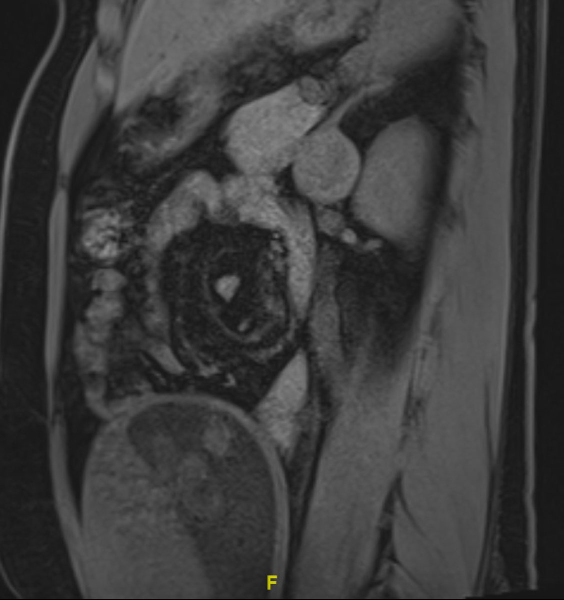 SimoneCrivella2's tweet photo. Today, good use of the small print of #SP robot at #UIC. Left #adrenalectomy for 4 cm #pheocromocytoma in 24 weeks pregnant patient. Uneventful resection with #minimalaccess. Both patients (mother and baby) safe and sound! https://t.co/o1MLW4KN13