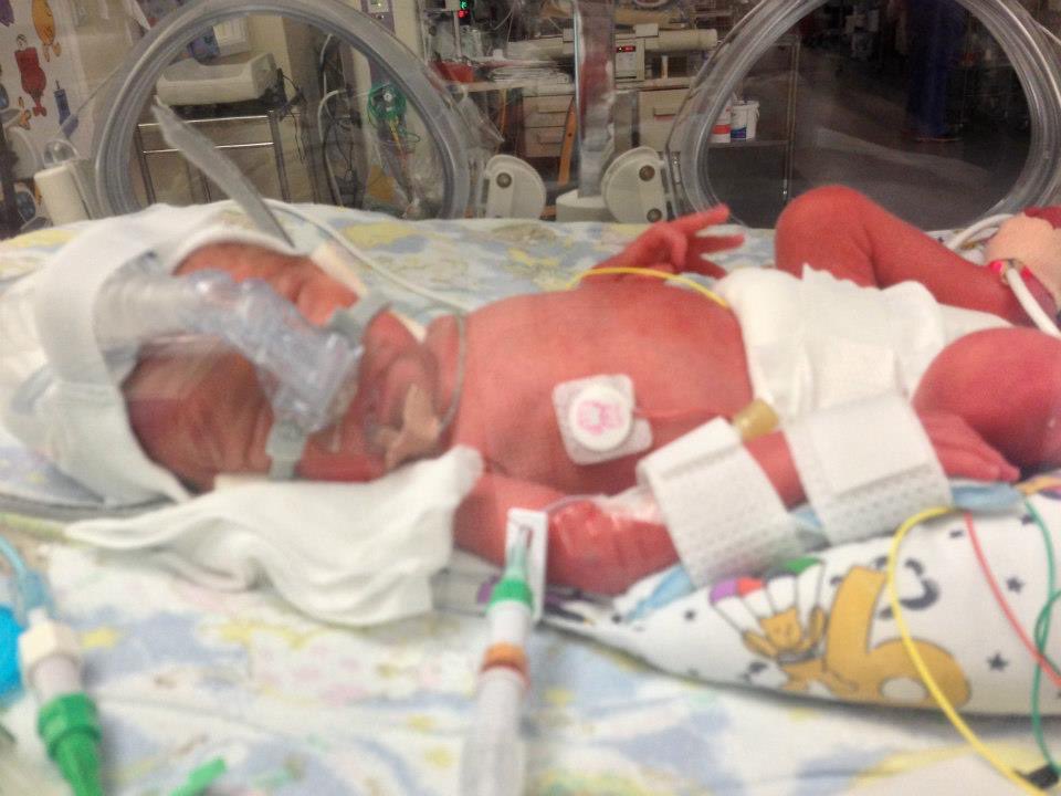 missdevine77's tweet image. Word prematurity day…then and now
8 years on we have 2 sassy little minxes. Born at 31 weeks, due to pre eclampsia, I’ll always be so grateful to the wonderful staff at NICU Wishaw for the care the girls received. 💜💜
#WorldPrematurityDay 
@wishawneonatal 
@NHSLanarkshire