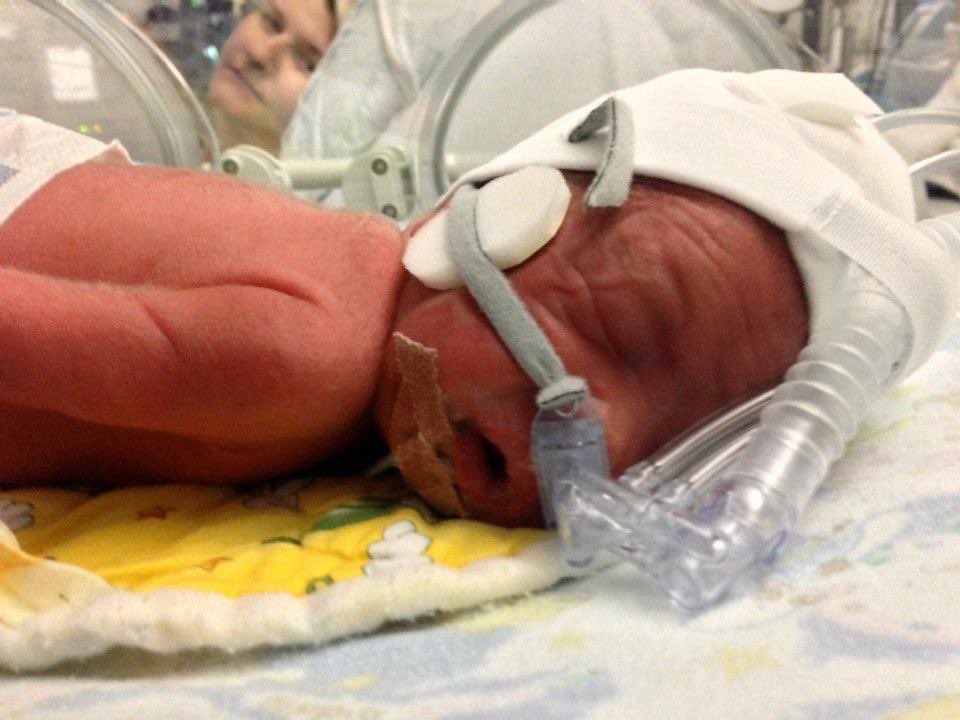 missdevine77's tweet image. Word prematurity day…then and now
8 years on we have 2 sassy little minxes. Born at 31 weeks, due to pre eclampsia, I’ll always be so grateful to the wonderful staff at NICU Wishaw for the care the girls received. 💜💜
#WorldPrematurityDay 
@wishawneonatal 
@NHSLanarkshire