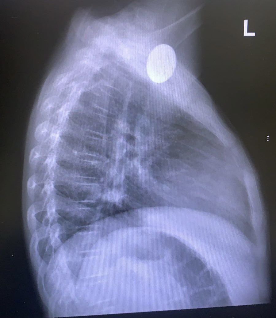 i_eittch's tweet photo. Retained esophageal foreign body in asymptomatic patient
(for more than 5 years!) https://t.co/ccMNlCTz36