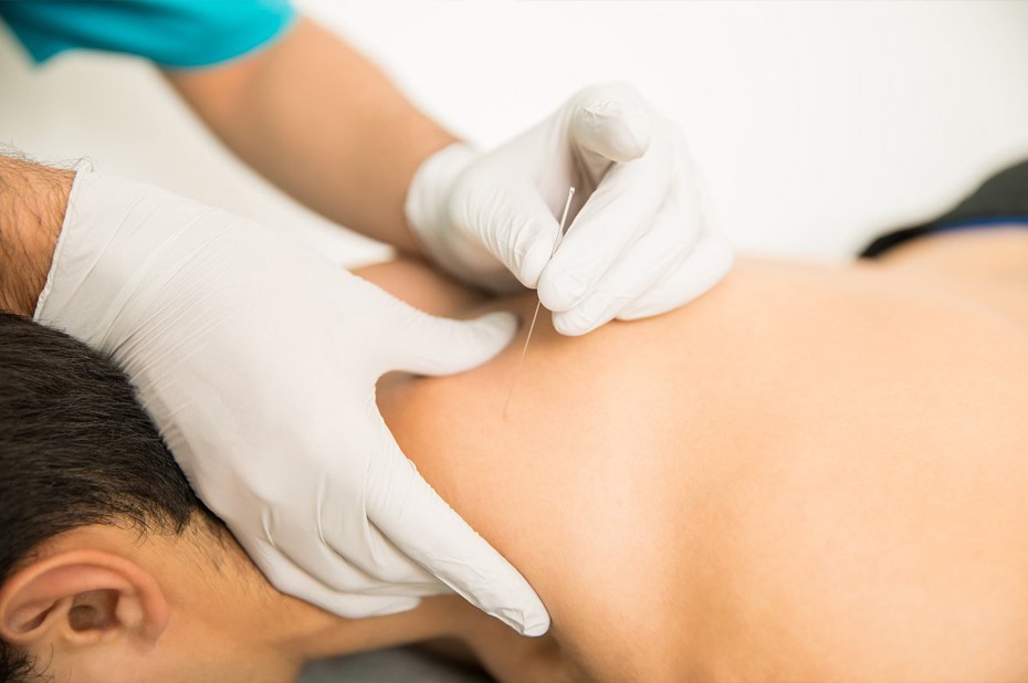 alshifa_care's tweet photo. الإبر الجافة (dry needle)
- إبر رقيقة يتم وخزها في العقد العضلية (بقعة في العضلة تسبب الألم عند الضغط عليها)
- تتميز بأنها خالية من أي مواد أو دواء
- تقنية سريعة لإزالة الشد والألم المصاحب للعقد العضلية https://t.co/TRYFiOOmN4