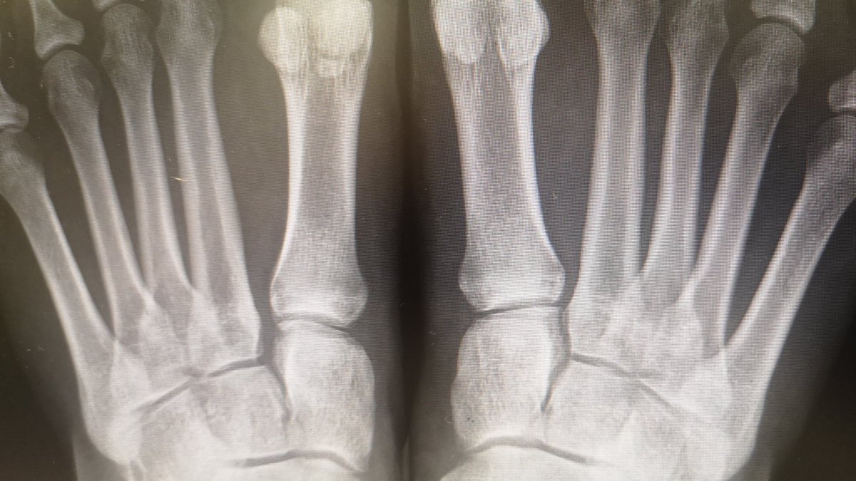 ToniTrauma's tweet photo. La importancia de la Rx en carga. Caída de aprox 3 escalones. Dolor en medio pie, pequeño hematoma. Acude a urgencias ➡️ Rx sin carga parece normal. Alta con Aines y reposo relativo.
Consulta a los 10 días ➡️ Rx carga y comparativa contralateral ➡️ 😖 https://t.co/7ZLbIV5Tkv