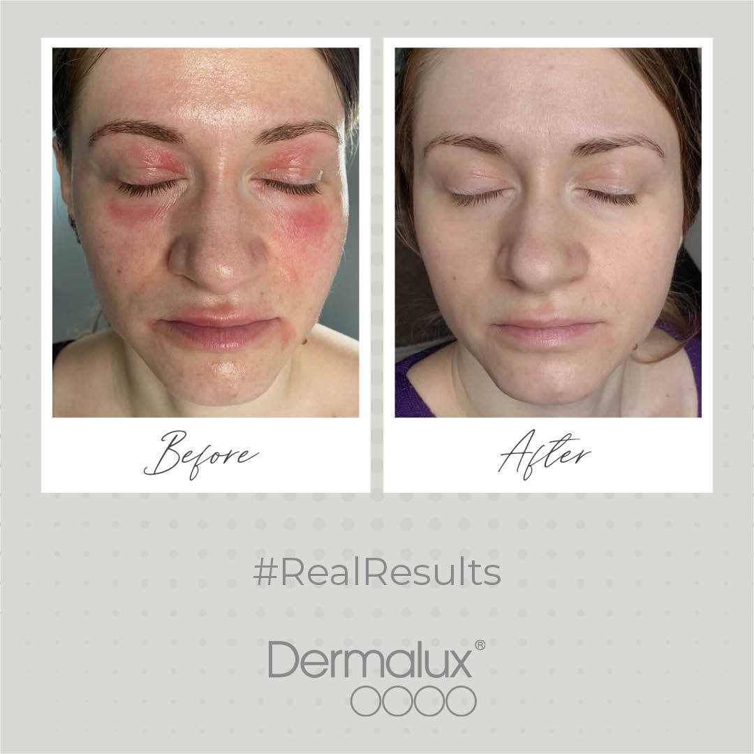 dermaluxled's tweet image. Thank you to Eletha Skin for sharing these incredible results. 

The client had 3 treatments with the Dermalux Flex.

‘The results are like no other.'

#realresults #sensetiveskin #problemskin