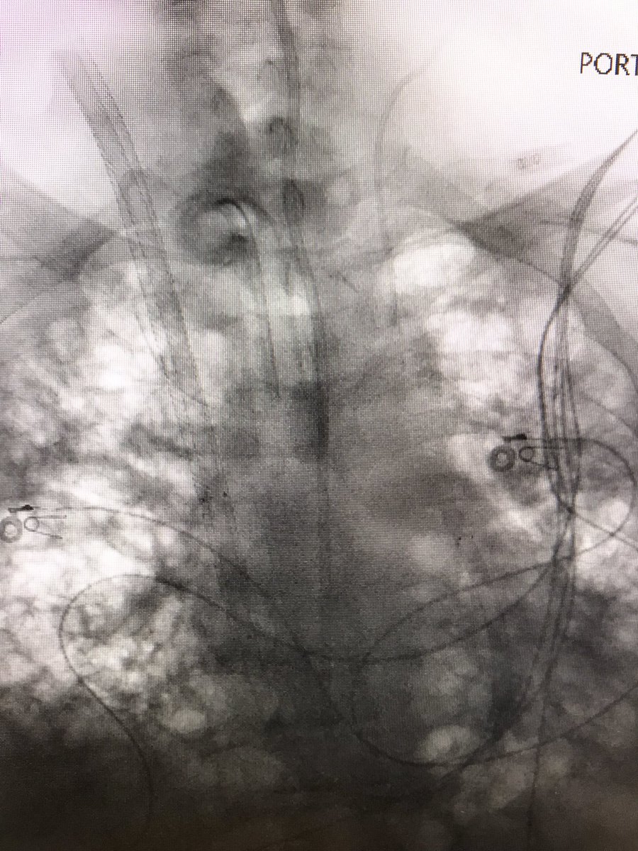 GCudemusMD's tweet photo. First Use of #ProtekDuo dual lumen to provide #VVECMO and #RVSupport for #ARDS #COVID19 at @NCHFlorida @NCH_Heart .Congratulations to our #MCS team @DrBrianSolomon @StephenDorazio2 @md_viviana. Thanks to our leadership @PaulHiltz @RCubedduMD https://t.co/KNvoc6eG9f