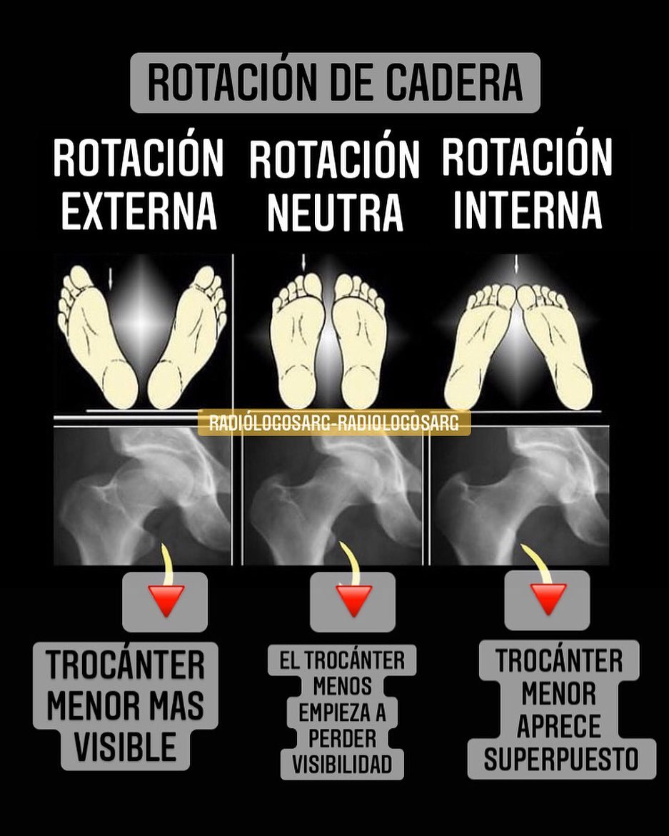 ⚠️RELACIÓN ENTRE LA ROTACIÓN DE CADERA Y LA VISIBILIDAD DE LOS TROCÁNTERES ⚠️

🔵 Rotación Interna: El cuello del fémur se alarga y el trocánter menor queda oculto.
🔴 Rotación Externa: El trocánter mayor se superpone al cuello del fémur. Trocánter menor prominente.