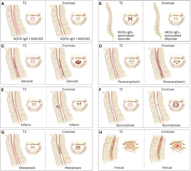 DrJPMansilla's tweet photo. 🤪Excelente resumen de patrones radiológicos en mielopatías y mielitis😎, en relación al curso de neuroinmunología de @neurovalpo🎓. Extraído del continuum de este año 📕
doi: 10.1212/CON.0000000000000900
#Neurology #NeuroTuit #NeuroTwitter https://t.co/DQgm7ISwRA