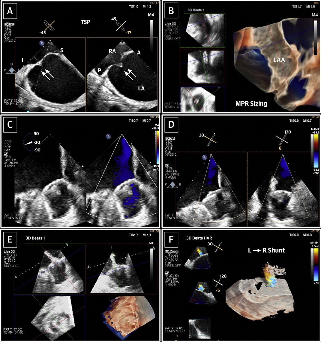 First Experience With a Novel Live 3D ICE Catheter to Guide Transcatheter SHD interventions sciencedirect.com/science/articl…