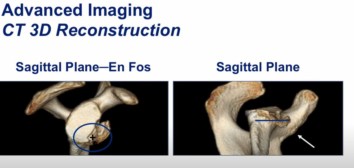 drchrisahmad's tweet photo. 💡💡💡 Surgical Spotlight - Shoulder Remplissage

All You Need to Know: https://t.co/nxU31K7cpv☑️

#sportsmedicine #orthopedics #shoulder #instability #shoulderpain #shoulderinjury #shoulderinjuries #disclocation #bonedeficiency @OrthoColumbia  ⭐️⭐️⭐️⭐️⭐️ https://t.co/OHwNK4J96B