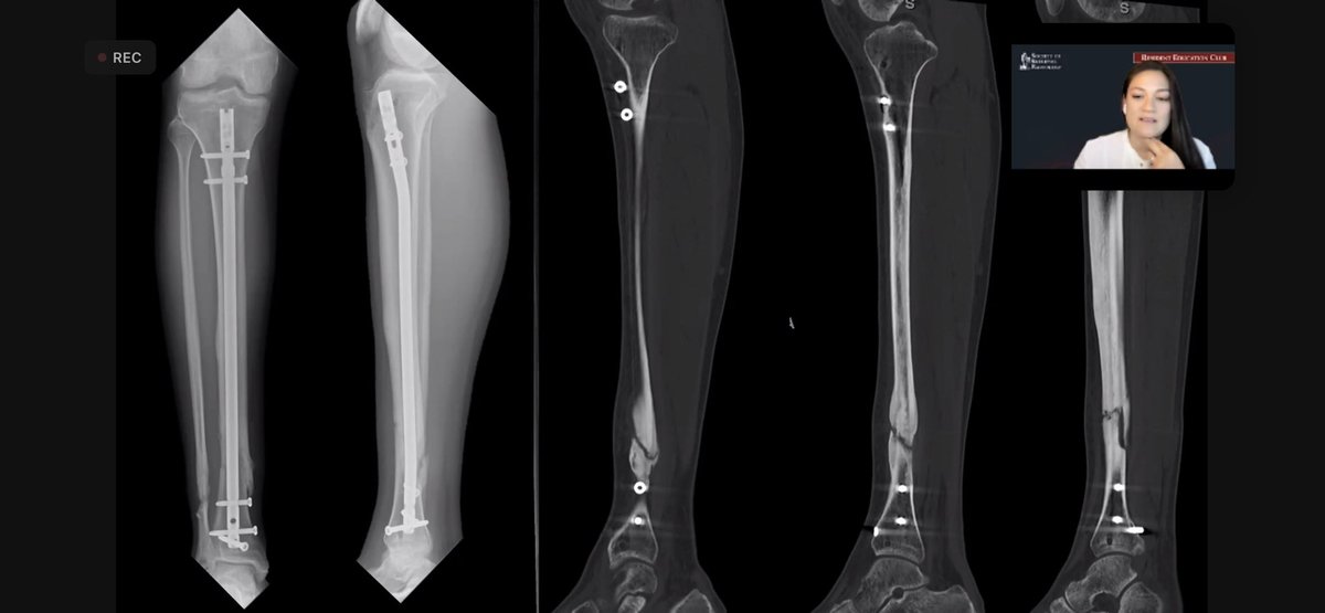 Maryam Soltanolkotabi (@mskmarsol) on Twitter photo What a wonderful REC by Dr. Mills, moderated by <a href="/cychang1414/">Connie Y Chang</a>
Not too late to join us at skeletalrad.org/resident-educa… <a href="/SSRbone/">Society of Skeletal Radiology</a> <a href="/ssr_rwg/">SSR_RWG</a> <a href="/MskUtah/">Utah MSK Rads</a> What a wonderful REC by Dr. Mills, moderated by <a href="/cychang1414/">Connie Y Chang</a>
Not too late to join us at skeletalrad.org/resident-educa… <a href="/SSRbone/">Society of Skeletal Radiology</a> <a href="/ssr_rwg/">SSR_RWG</a> <a href="/MskUtah/">Utah MSK Rads</a>