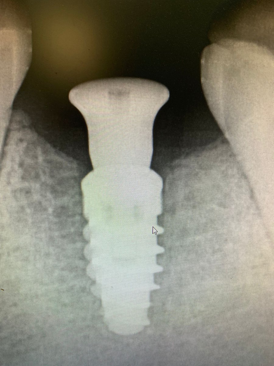 MischInstitute's tweet photo. After S5 - last weekend Dr Gebrehiwot is putting Dr. Resnik’s wisdom to work! Congratulations on a job well done!  #dentalimplant #DentalImplant #dentist #oralhealth #Dentist https://t.co/RGb7kovUl7