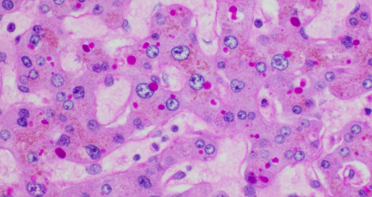 Surg Path Case of the Week: PAS-D stain. What do you think is most likely? More history and follow up next week #PathTwitter #GIPath #PathBoards Pic by <a href="/LiliLeeMD/">Lili Lee, MD</a> 
A Fibrolamellar variant HCC
B Congestive hepatopathy
C Alpha-1-antitrypsin deficiency
D Fibrinogen storage disease