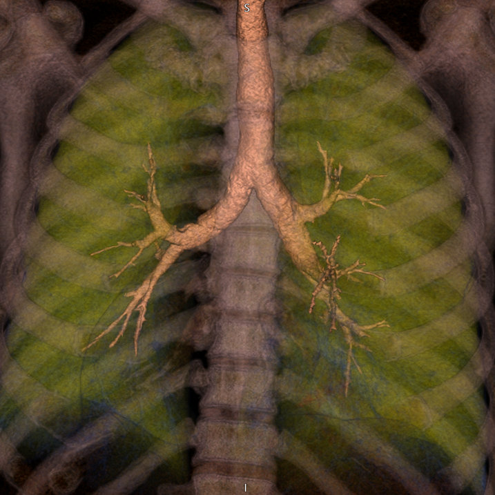 CtSpectral's tweet photo. Mirror image bronchial branching pattern in situs inversus on 3D CT.
#FOAMed #ChestRadEd https://t.co/psZxKtxQ44