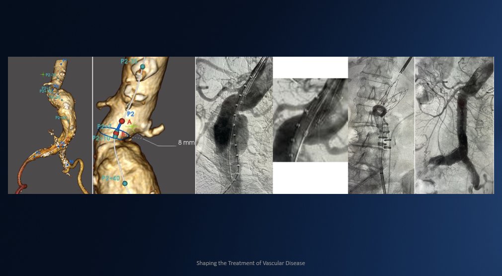 endologix's tweet photo. A patient with this 10mm short &amp; 59° angled neck comes in for an #EVAR. What stent graft would you choose to implant? Learn more about ALTO today! https://t.co/sOam7F9Fm4 #EVARevolved https://t.co/Nq8XZy73JL