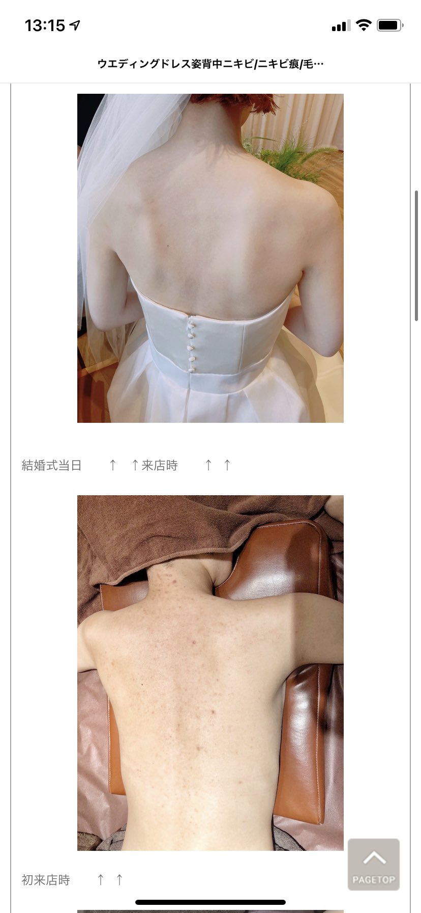 Cocotii グリーンピール専門店 背中ニキビ お尻 二の腕 顔 脚 毛孔性苔癬 グリーンピール ハーブピーリング お悩み ウエディングドレスを綺麗に着たい 背中ニキビ ニキビ痕 毛孔性苔癬 背中上部とうなじ 8回終了時写真です 綺麗なドレス姿