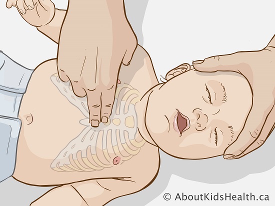 Сердечно легочная реанимация массаж сердца. Непрямой массаж сердца у детей. Точка компрессии грудной клетки у новорожденных. Непрямой массаж сердца ребенку 5 лет. Техника непрямого массажа сердца новорожденному.