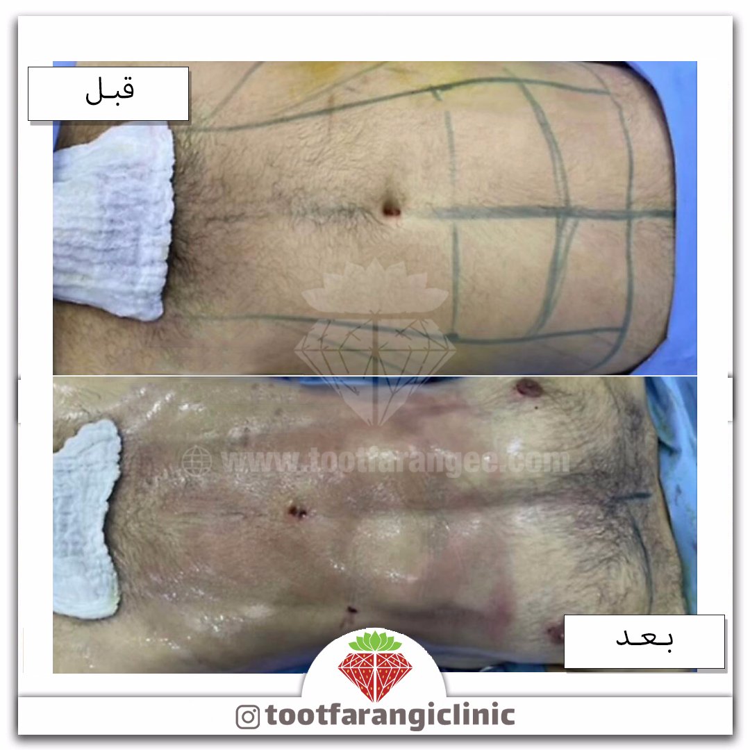 Tootclinic's tweet photo. #ویزر #لیپوماتیک #پیکرتراشی #سیکسپک #تناسب_اندام https://t.co/vXWtdH9Kfj