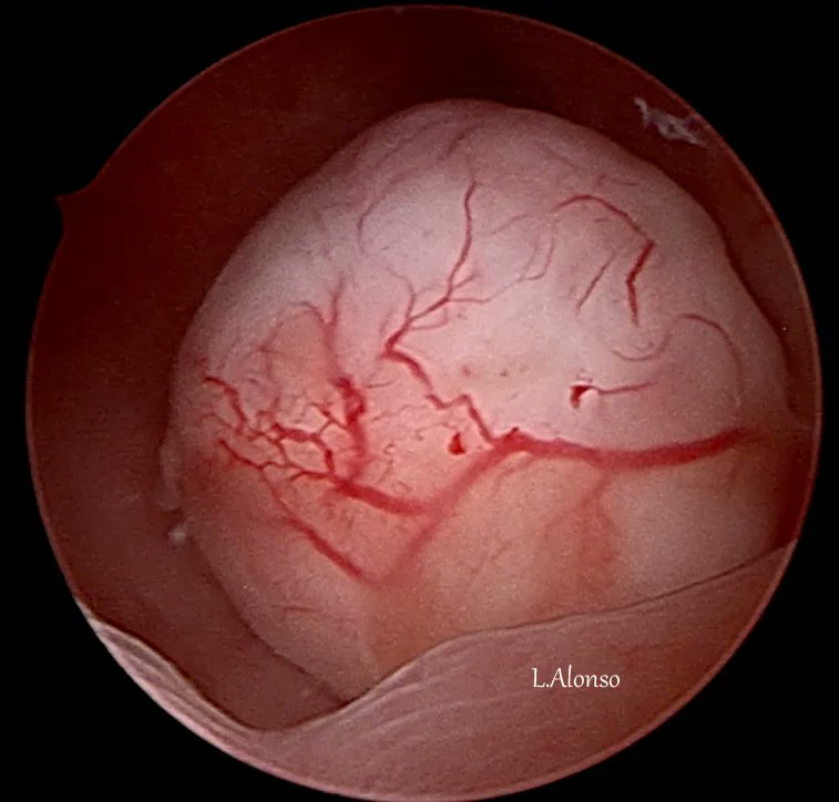 Although frequently asymptomatic, myomas may be associated with menorrhagia, pelvic pain, bladder and bowel dysfunction from pressure, infertility, and recurrent pregnancy loss